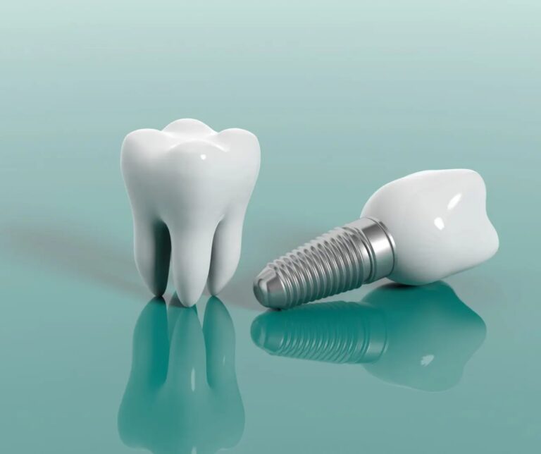 Dental Implants